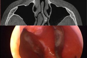 Завершение 2020 закрытием перфораций перегородки носа у двух молодых людей