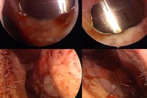 Завершение 2020 закрытием перфораций перегородки носа у двух молодых людей