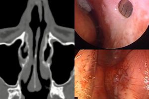 Завершение 2020 закрытием перфораций перегородки носа у двух молодых людей